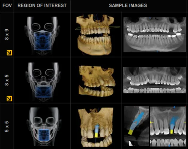 Campos de visión para tomografía dental Cone Beam en Vilcor