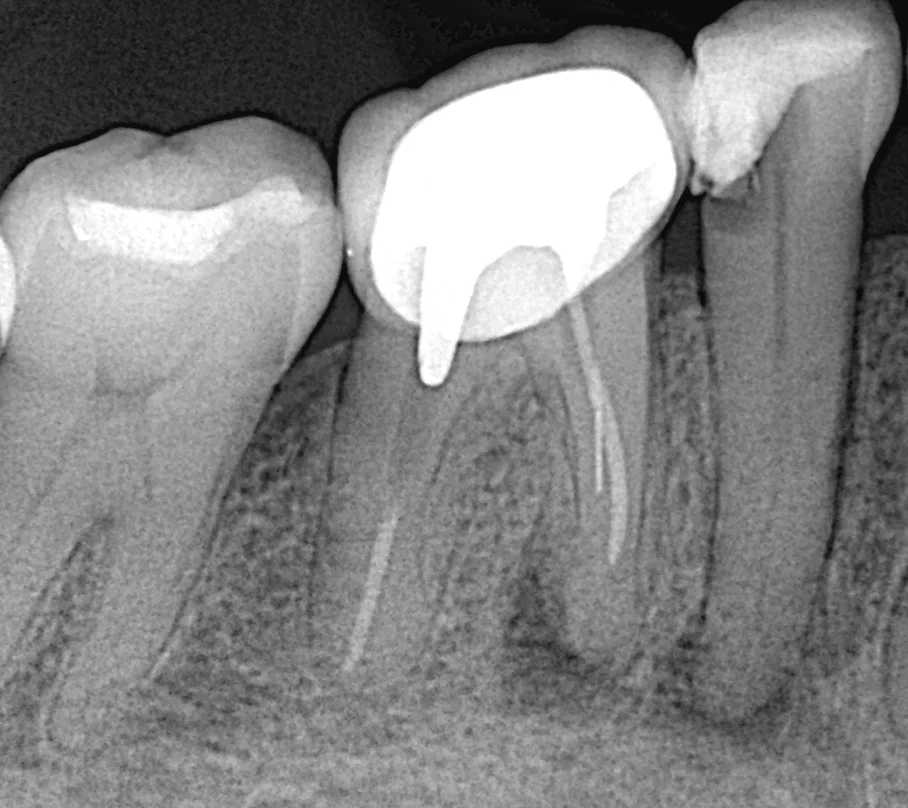 Radiografía periapical digital en Vilcor