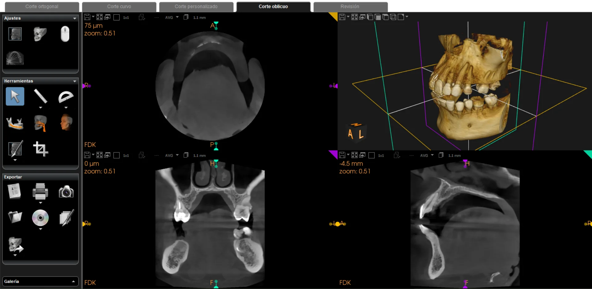 Tomografía dental Cone Beam 3D realizada en Vilcor