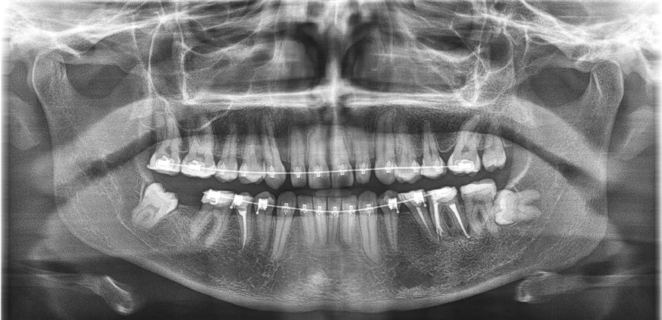 Radiografía panorámica dental realizada en Vilcor